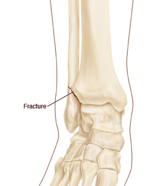 Ankle Fracture