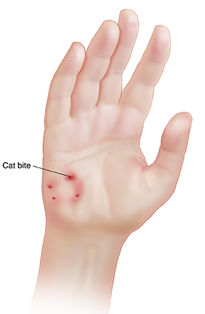 Palm of hand with cat bite marks.